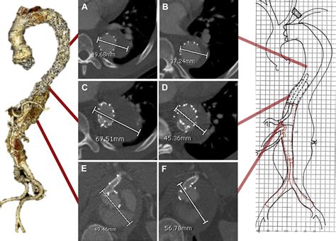 Lift Sandwich Grafting Enables Transfemoral Abdominal Aortic Branch