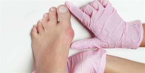 Why Do I Have Bunions Advanced Foot And Ankle Center Podiatry