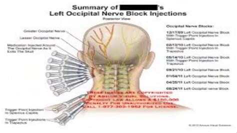 Occipital Neuralgia The Basics Occipital Neuralgia Neuralgia Symptoms