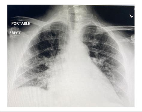 Chest X Ray Showed Right Sided Pulmonary Infiltrates Download