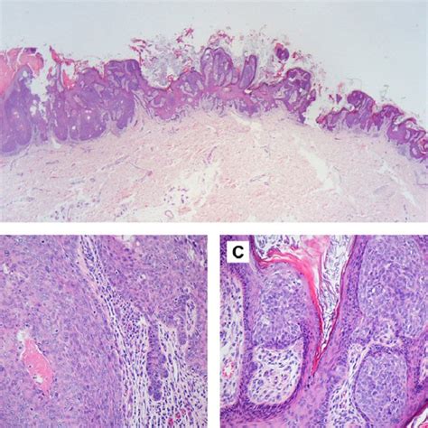 A The Porocarcinoma In Situ Shows Obvious Peripheral Palisading