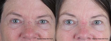 Scar Revision Before And After Weber Facial Plastic Surgery