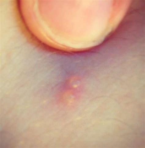 Here's how to treat the itchy, red rash. Caitlin Rosen on Twitter: "Sea lice stings! Small red ...