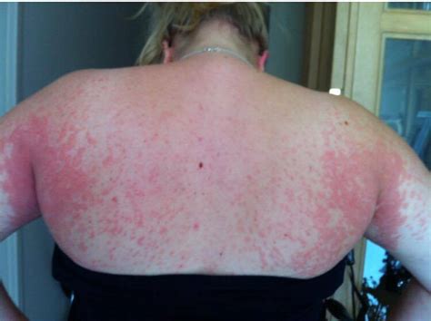 Pregnant Mums Rash Covered Her Whole Body ‘the Pain And The Itch Was