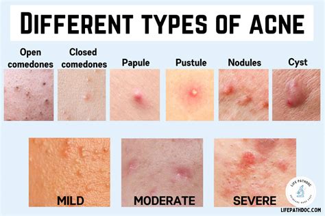 Different Types Of Acne With Pictures And Their Treatment