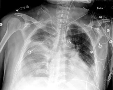 Malpositioned Right Internal Jugular Vein Catheter Radiology Case Radiopaedia Org