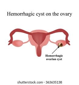 Endometritis Inflammation Endometrium Inflammation Uterus Infographics