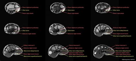 Head, neck, arm, foot, pelvis, etc. Roentgen Ray Reader: Anatomy of the Volar Branch of the ...