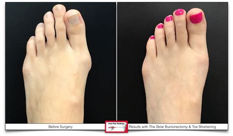 Cosmetic Foot Surgery Toronto Kicosmetic