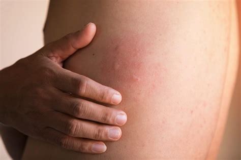 5 Ways To Treat Your Chronic Hives Catherine Fuller Md Allergy Asthma And Immunology Specialists