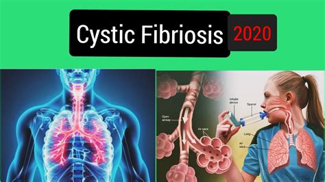 cystic fibrosis [signs and symptoms causes diagnosis and treatment of cystic fibrosis 2021