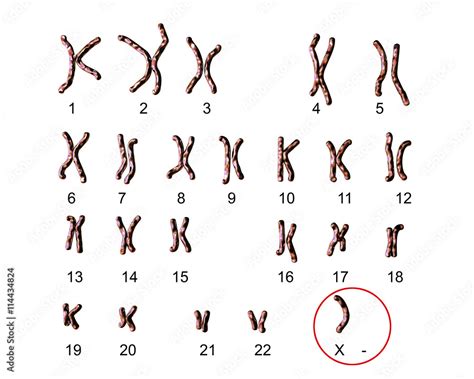 Turners Syndrome Karyotype Labeled X0 Karyotype 3D Illustration