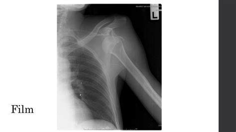 Antshoulder Dislocation