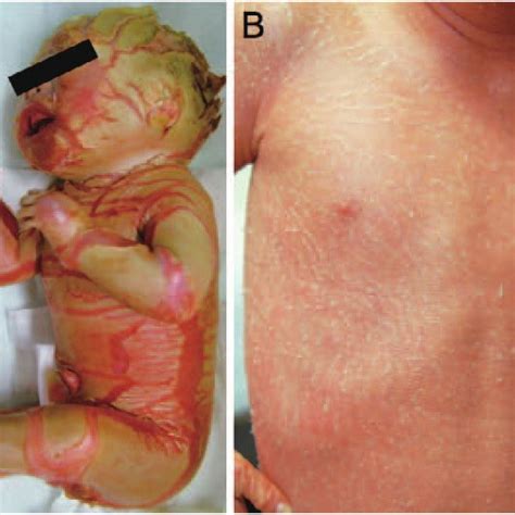 Clinical Features Of Ichthyosis A An Hi Patient Harboring A