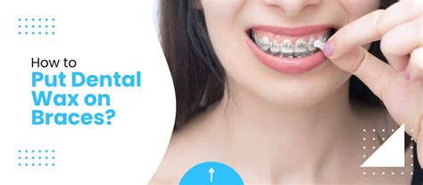 How To Put Dental Wax On Braces Dentist Contract Attorney