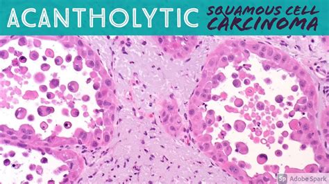 Squamous Cell Carcinoma Acantholytic Pattern Dermatopathology Dermpath Pathology Dermatology
