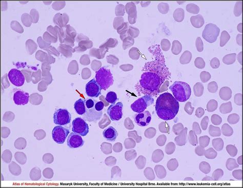 Myelodysplastic Syndrome With Ring Sideroblasts And With Multilineage