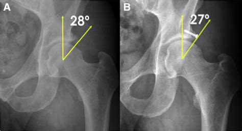 Radiographic Anteroposterior View On A Left Hip Comparing The A