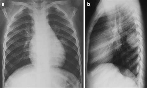 Round Pneumonia In A 9 Year Old Boy Frontal A And Lateral B Chest