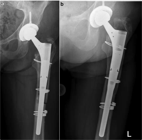 Aseptic Revision Of Total Hip Arthroplasty With A Single Modular