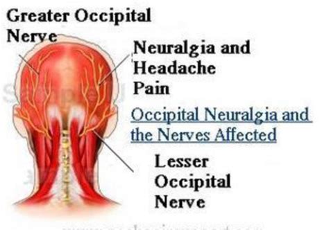 Use Of Occipital Nerve Block In The Emergency Department