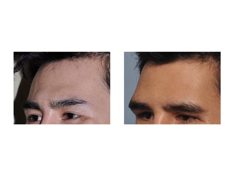 Custom Forehead Implant Result Oblique View Dr Barry Eppley