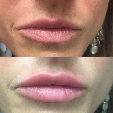 Sultry Lip Enhancement Lip Enhancement Juvederm Lips Lip Augmentation