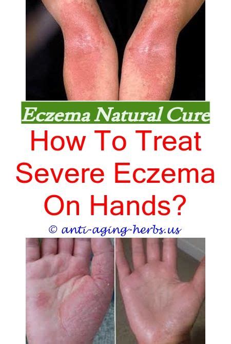 Ring View Ringworm Vs Eczema In Toddlers Pics