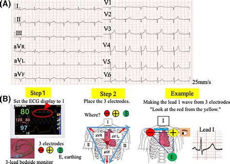 Creating 12‐lead Electrocardiogram Waveforms Using A Three‐lead Bedside