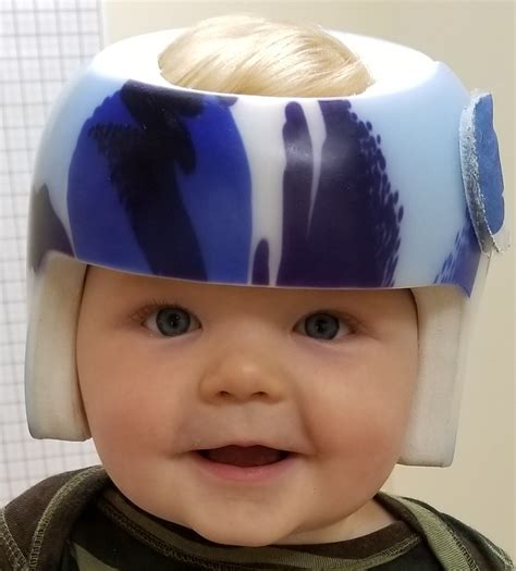 27 Best Ideas For Coloring Baby Misshapen Head Helmet