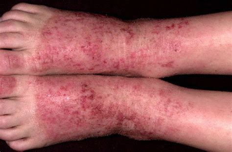 Skin Disease Soxal Hseq Portal