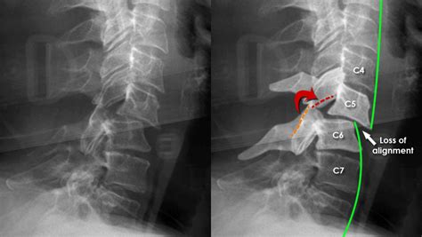 Trauma X Ray Axial Skeleton Gallery 1 Cervical Spine Facet