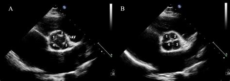 Congenital Quadricuspid Aortic Valve Associated With Aortic Insufficiency And Mitral