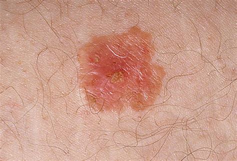Pictures Of Skin Cancer Skin Cancer Melanoma Pictures