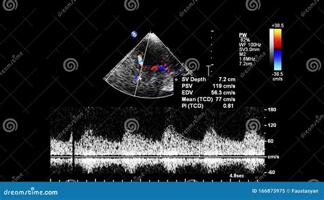 Pulse Wave Doppler Ultrasound Examination Stock Image Image Of