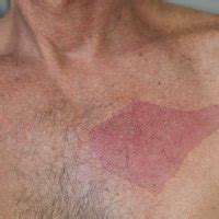 Laser hair removal can be painful. How to Treat a Burn From Nair (with Pictures) | eHow