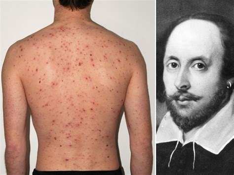 A Pox Upon Him Shakespeare Accused Of Causing Misery To People With