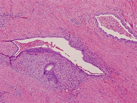 Endometriosis risk factors and symptoms, including which symptoms indicate need for diagnostic tests. Cutaneous Endometriosis (umbilical endometriosis ...