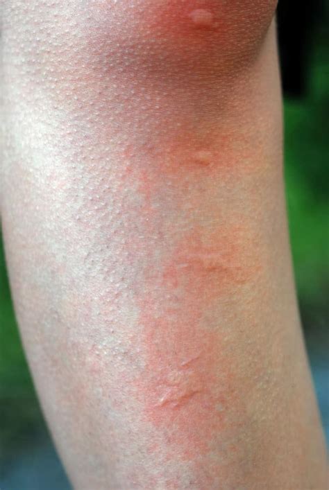 Mosquito Bite Allergy Symptoms Mosquito Bite Reaction Meaning Lupon