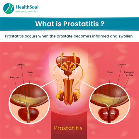 Prostatitis Symptoms Diagnosis And Treatment Healthsoul