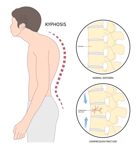 The Impact Of Osteoporosis On The Spine New Jersey Comprehensive