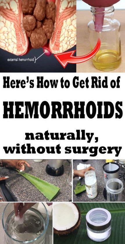 get rid of hemorrhoids naturally hemorrhoids homeremedy naturalhealing home remedies for