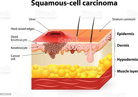 Squamous Cell Carcinoma Stock Illustration Download Image Now Istock