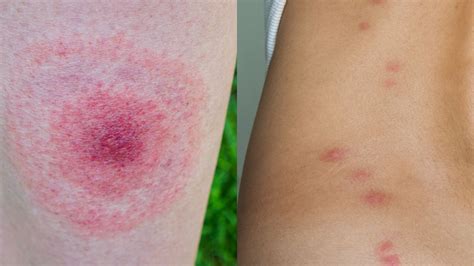 19 Common Bug Bite Pictures How To Id Insect Bites And Stings