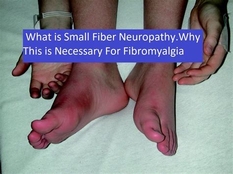What Is Small Fiber Neuropathy Why This Is Necessary For Fibromyalgia