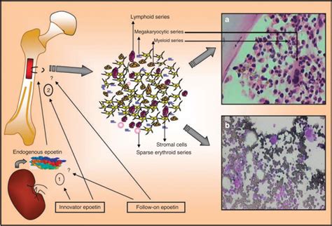 Prca arises when damage occurs to the bone marrow, where it is unable to produce a sufficient amount of red blood cells. Pure red cell aplasia due to follow-on epoetin - Kidney ...