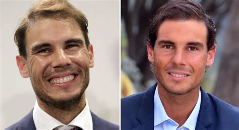 On his mother's side, rafael is the. Célébrités qui ont fait des greffes de cheveux | Capilclinic