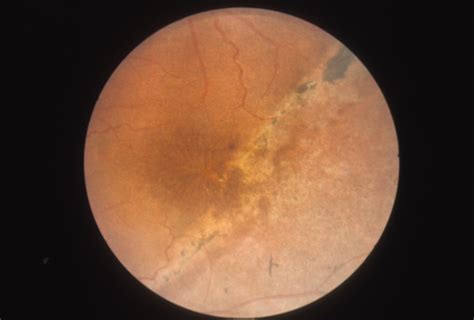 Retinoschisis Juvenile Hereditary Ocular Diseases