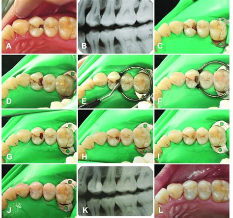 Steps Of Restoration In Tooth 24 A Preoperative Image Of 24 B