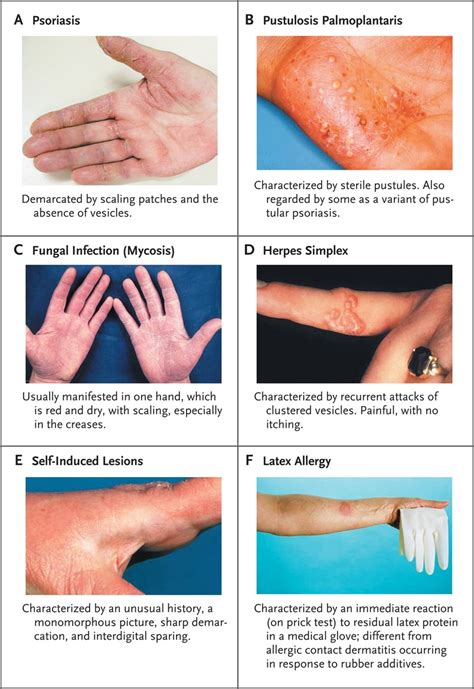Hand Eczema Nejm